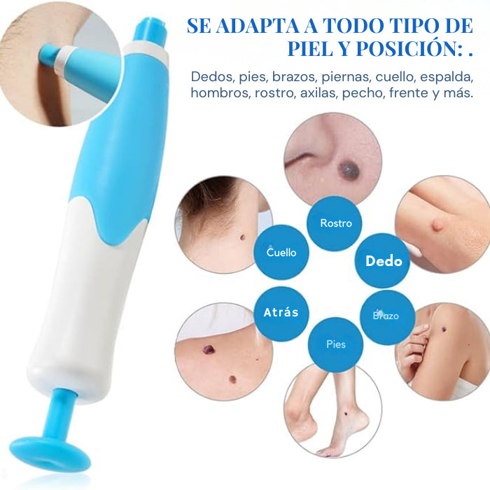 REMOVEDOR DE VERRUGAS