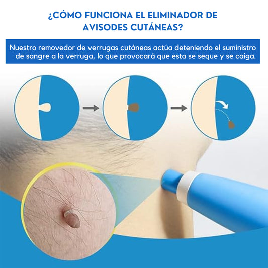 REMOVEDOR DE VERRUGAS